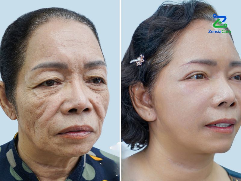 Before and After Facelift Surgery in Vietnam