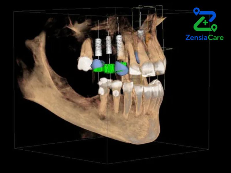Dental-implant-3d-ct-scan
