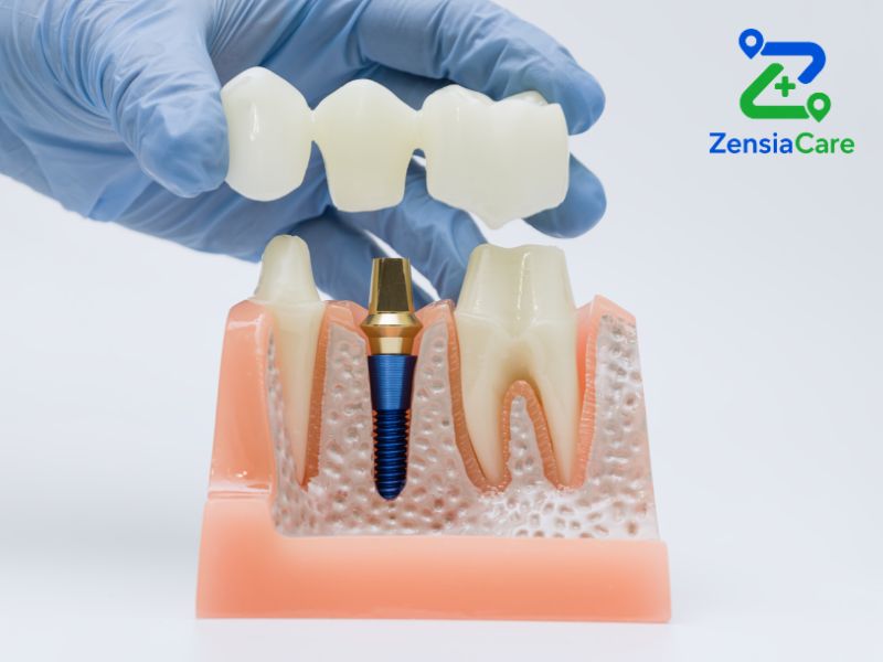Final crown or prosthesis after dental implant treatment in Vietnam