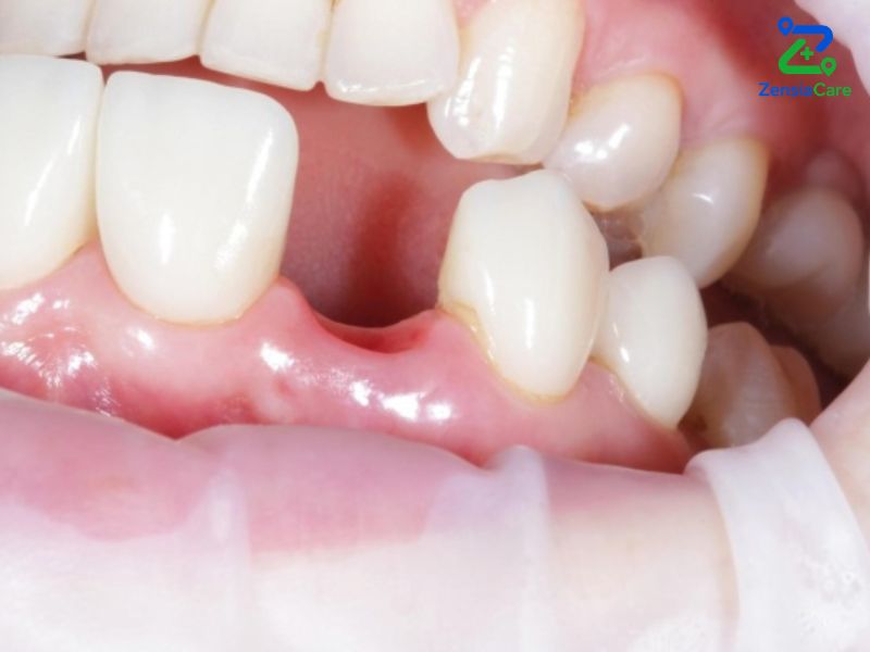 Zirconia Crowns and Bridges
