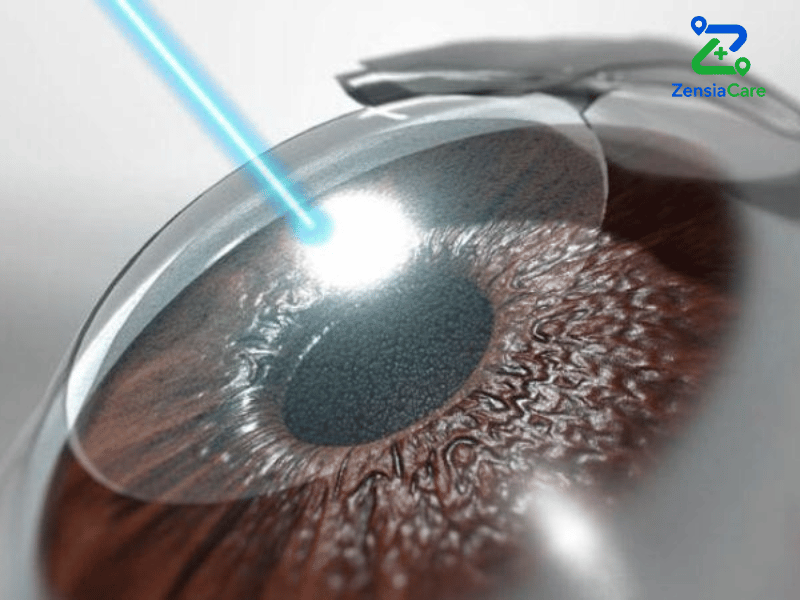 SMILE Pro Eye Surgery in Vietnam