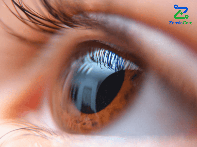 Cataract Surgery