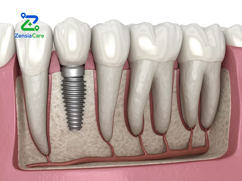 dental treatment cost in Vietnam vs Australia